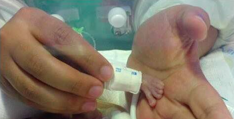 中国最小婴儿 捧在掌心里的孩子（五胞胎之一）